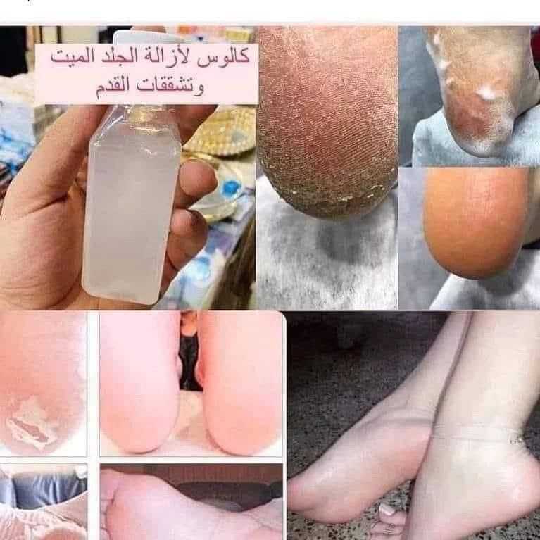 كالوس لازاله اللحم الميت بالقدم
